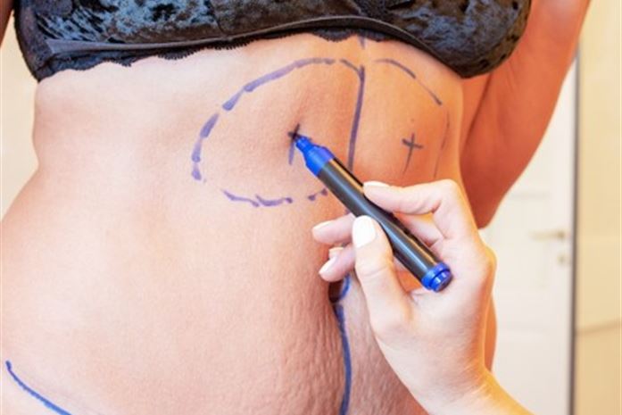 Historia mojego brzucha: chirurgia estetyczna jako sposób na powrót do ciała